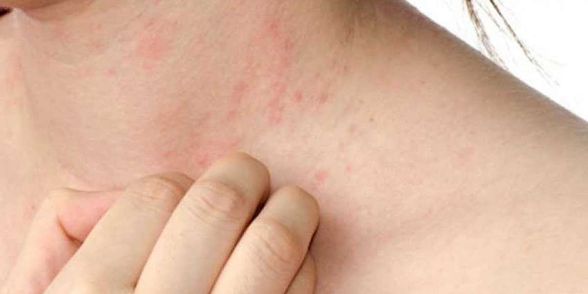 Understanding What Urticaria Treatment Can Do For You