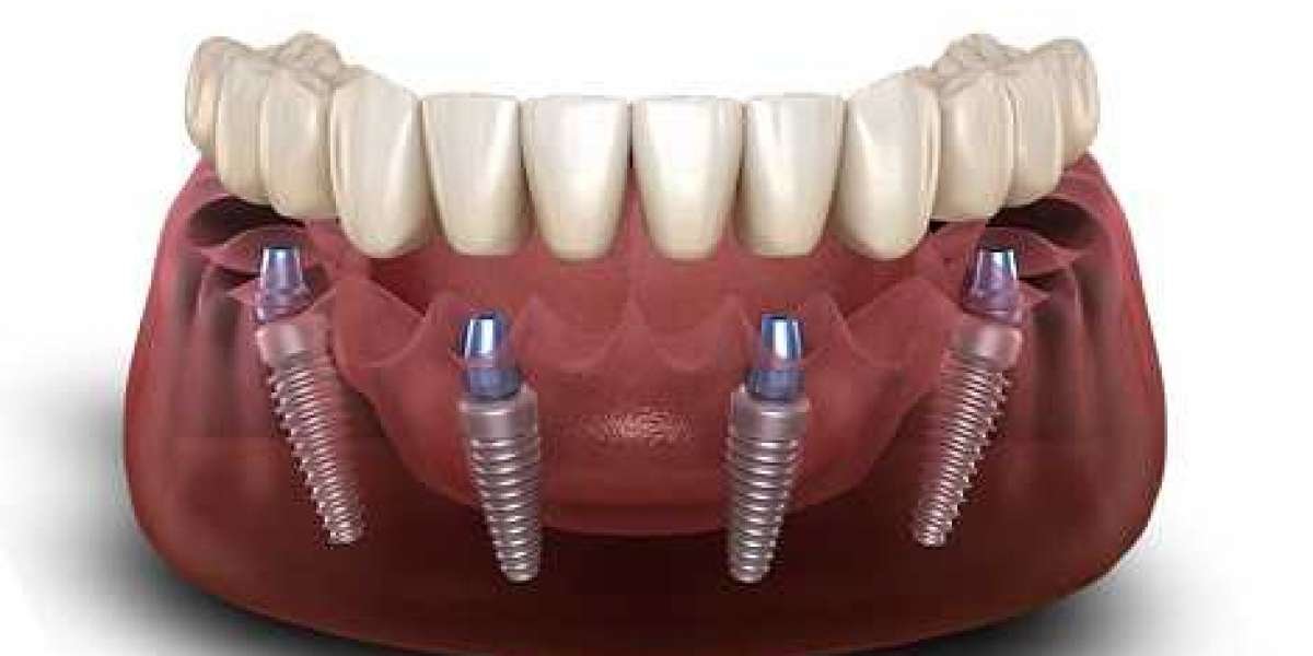 Dental Implant Solution: Types, Benefits, and How to Choose the Right One