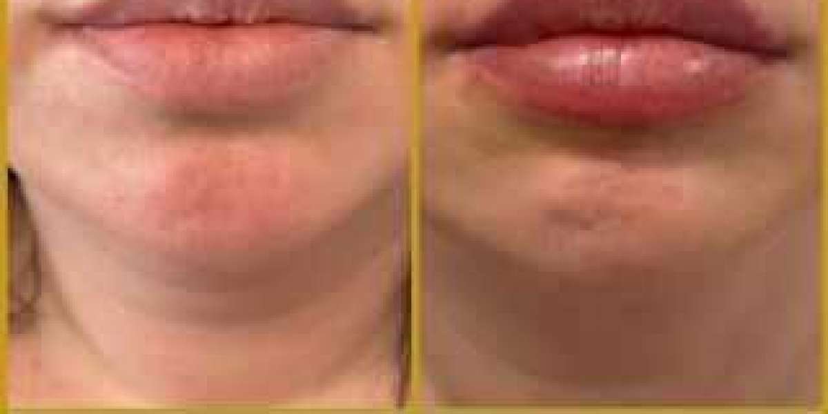 Lip Filler: What It is, How It Works, and the Best Choices
