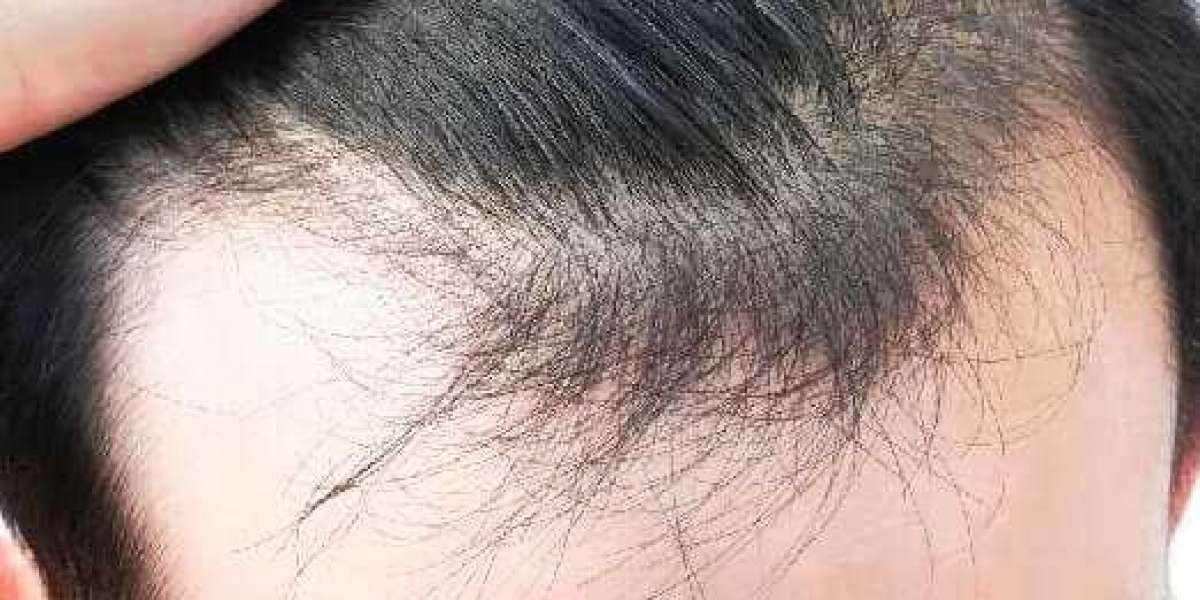 Restore Baldness with Hair Transplant in Bangalore
