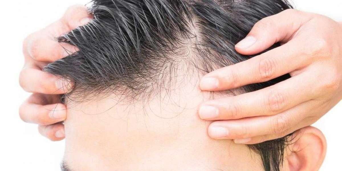 Major Male Pattern Baldness Causes