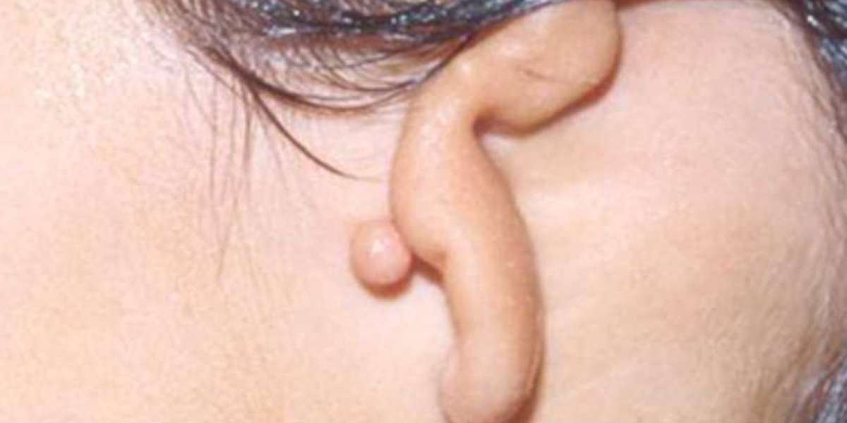 Ear Reconstruction Surgery by Dr. Parag Telang