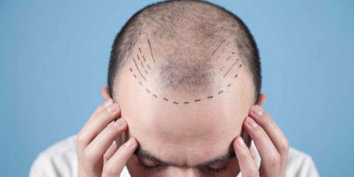 Best Hair Transplant in Indore