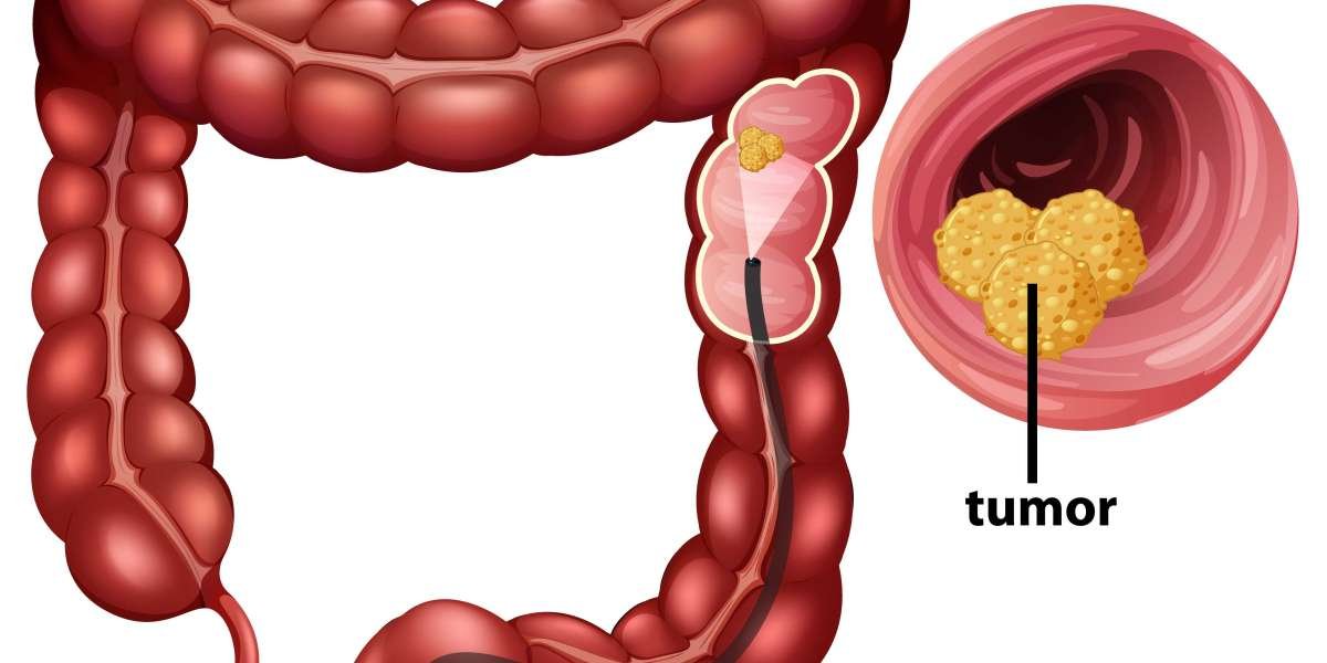 Colorectal Cancer Screening Market Size, Trends, and Forecast (2023-2033)