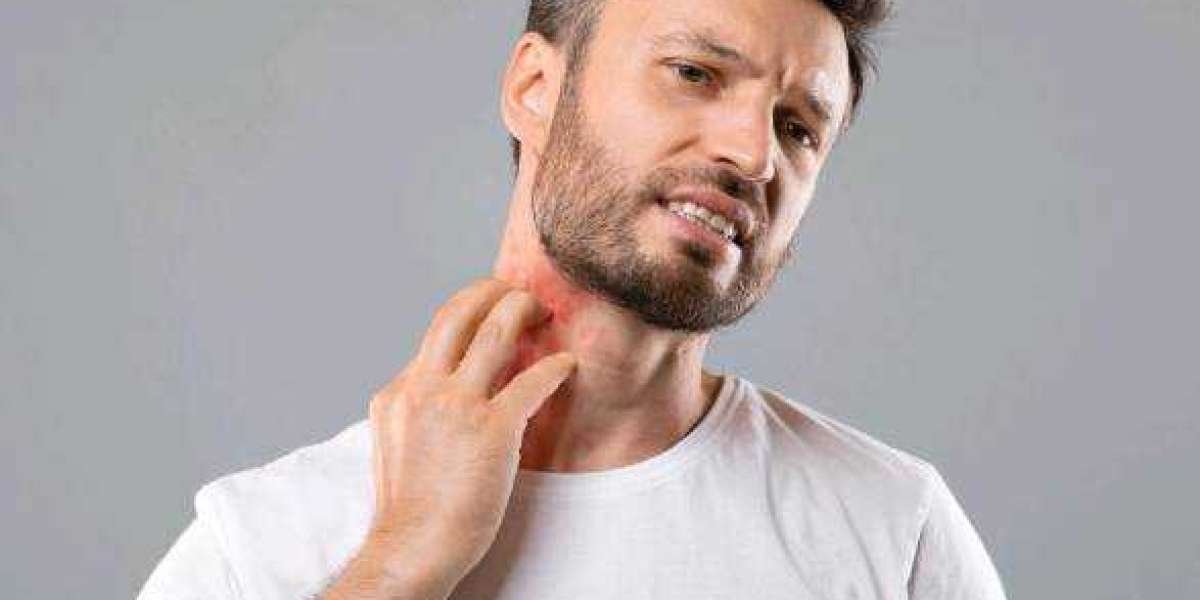 Eczema Treatment In Dwarka