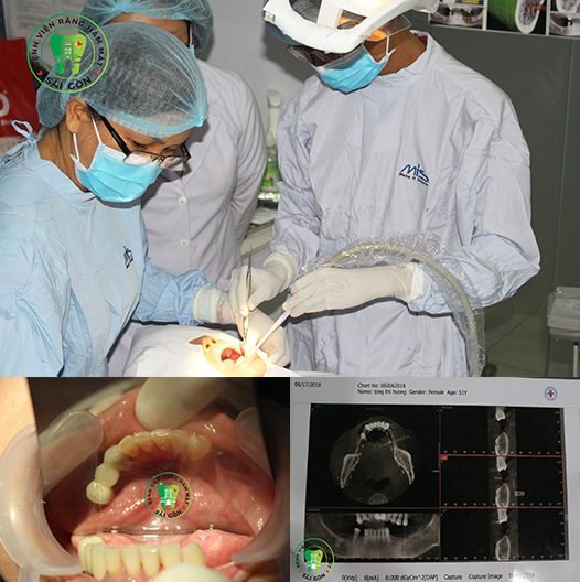 Chi phí trồng răng vĩnh viễn - Bệnh Viện Răng Hàm Mặt Sài Gòn