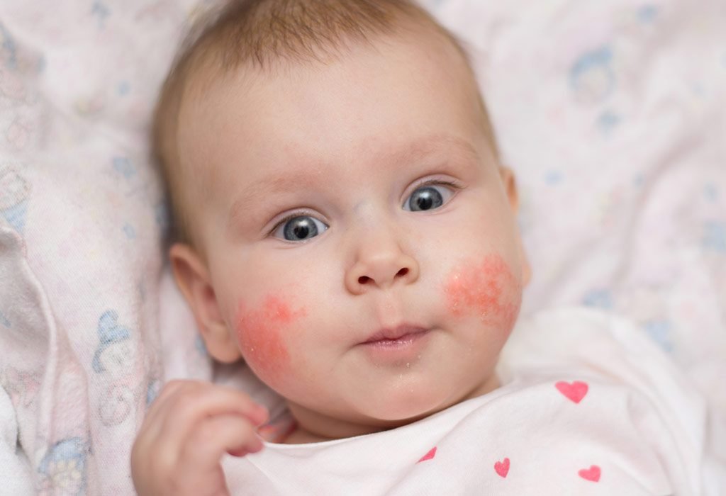 Eczema In Children: Diagnosis, Treatment, And Care | BlogTheDay