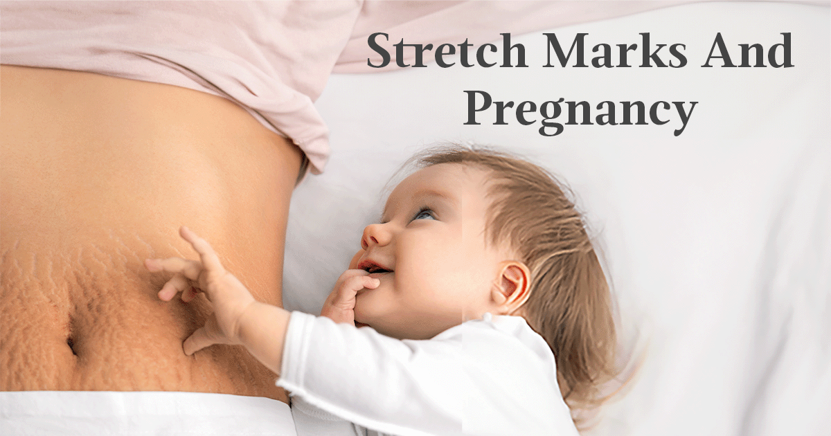 Stretch Marks During Pregnancy: Everything You Should Know