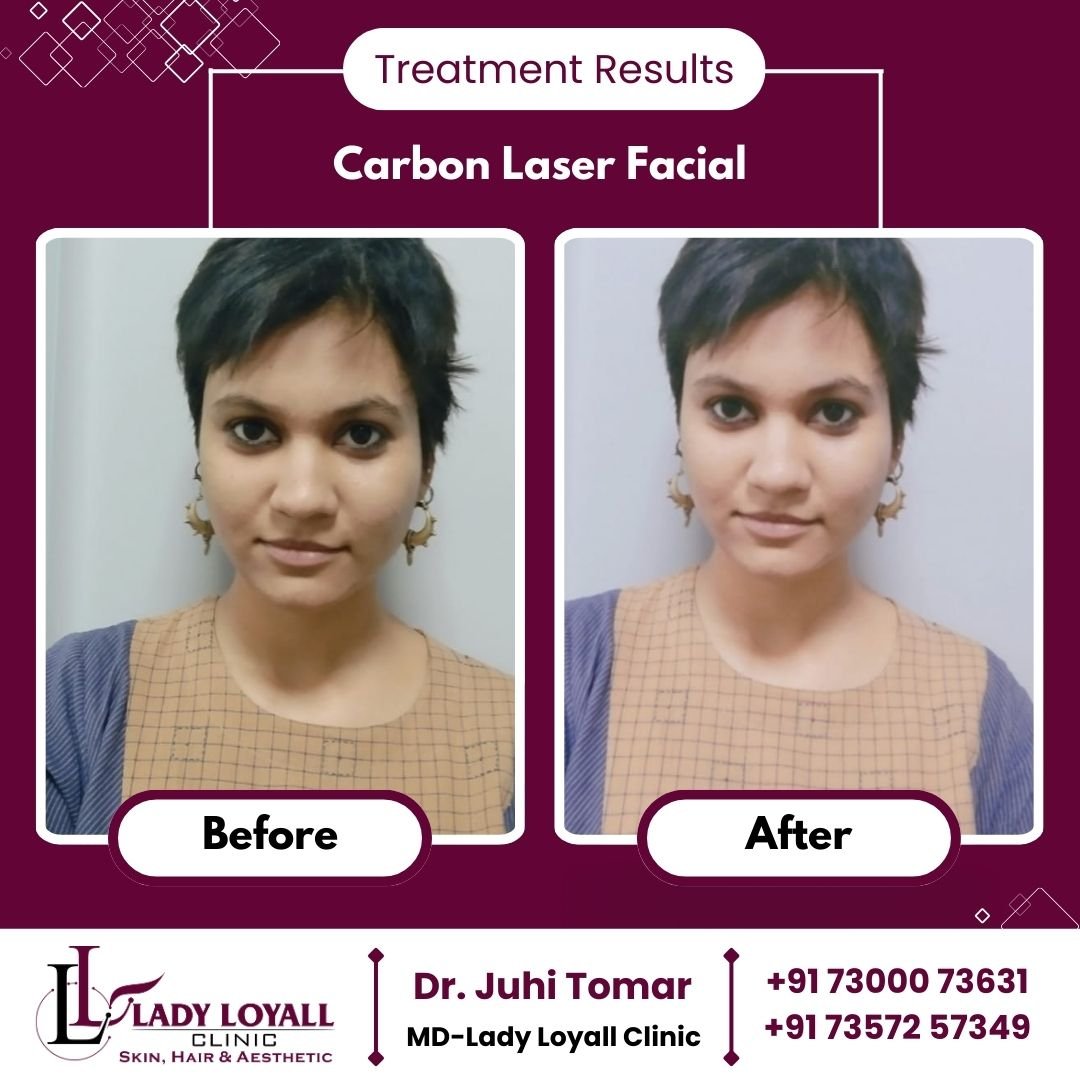 Hydra Facial in Jaipur, Carbon Laser: Lady Loyall Clinic