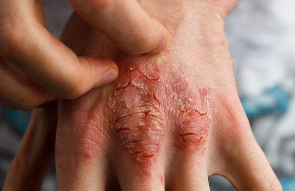 Best Eczema Treatment in Delhi | Dermasure Clinic