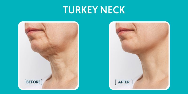 Turkey Neck: Causes, Treatment Options, and Exercises for a Firm Neck