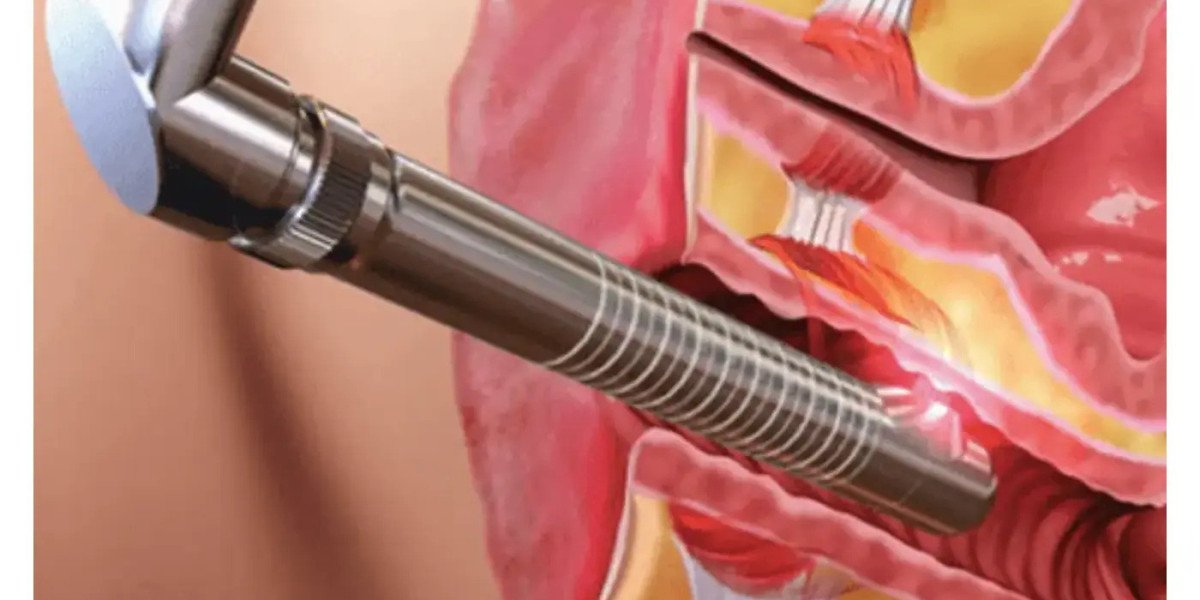 What Is Vaginal Rejuvenation Treatment and Who Needs It?