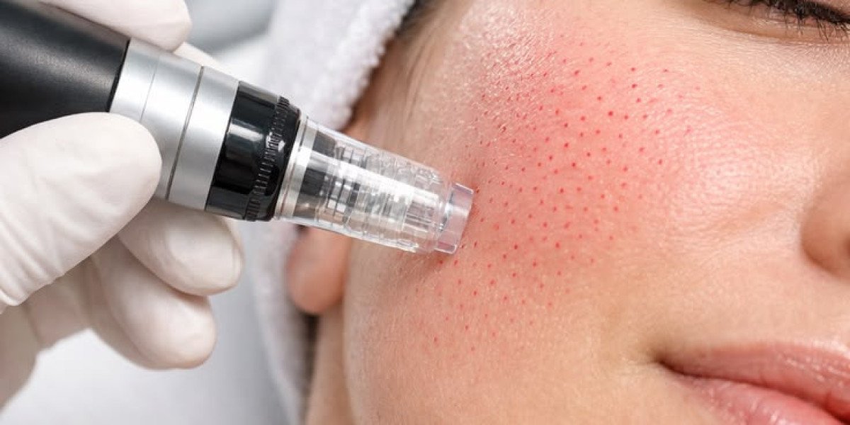 What Should You Know Before Choosing Microneedling in Islamabad?