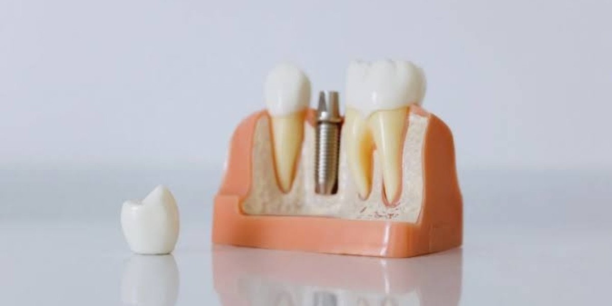 What to Expect During a Dental Crown Procedure: From Consultation to Final Fit
